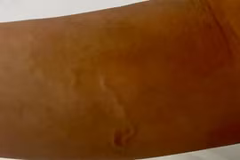 Ăn gỏi cá, nam thanh niên nhiễm giun, ký sinh trùng bò lổn nhổn dưới da