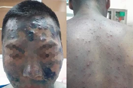 Nam thanh niên nổi mụn mủ chi chít toàn thân do tự mua thuốc trị thủy đậu