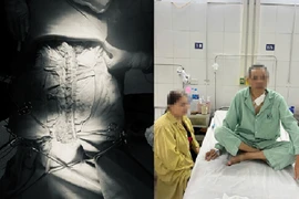 Cắt bỏ toàn bộ ống dạ dày, dùng đoạn đại tràng để tái tạo lại thực quản cho bệnh nhân ung thư