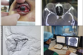 Suýt mù mắt sau tiêm Filler ở nước ngoài, nữ bệnh nhân về Việt Nam cầu cứu bác sĩ