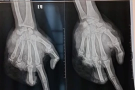 Liên tiếp trẻ vị thành niên nhập viện vì tự chế pháo nổ chơi Tết