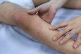 Số ca mắc sốt xuất huyết ở Hà Nội ở mức cao trên 2.500 ca 1 tuần