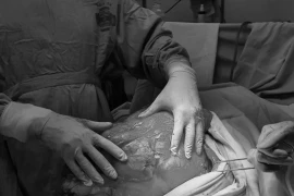 Hy hữu: Nam thanh niên 23 tuổi có khối u “khủng” ở bụng nặng hơn 8kg