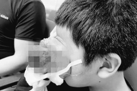 Bé trai 4 tuổi mang u “quái” lồi hết một bên mắt ra ngoài, nhiều bệnh viện từ chối mổ