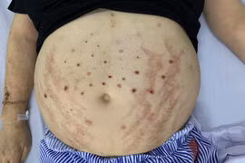 Dùng ong châm để trị giảm đau chân tay, người đàn ông 49 tuổi nhập viện