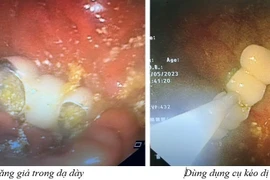 Người phụ nữ sơ ý nuốt 4 chiếc răng giả vào bụng