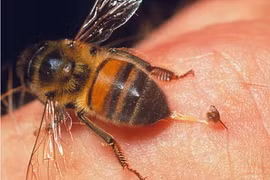 Đang ở trong nhà, bé gái 13 tuổi bị ong mật bay vào đốt gây sốc phản vệ nguy kịch