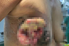 Mắc ung thư vú nhưng từ chối nhập viện để về đắp thuốc nam, nữ bệnh nhân nguy kịch