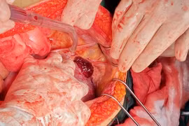 Hà Nội: “Báo động đỏ” toàn viện cứu sống thần kỳ sản phụ vỡ thai, chảy máu ồ ạt