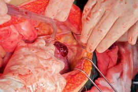 Hà Nội: “Báo động đỏ” toàn viện cứu sống thần kỳ sản phụ vỡ thai, chảy máu ồ ạt