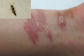 Vào “mùa” kiến ba khoang, nhiều người phải nhập viện vì viêm da