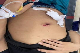 Cứu bệnh nhân sốc mất máu nặng, chảy 3-4 lít máu do thanh gỗ đâm thấu bụng