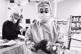 Hy hữu: Bệnh nhân có khối u máu gan khổng lồ, đường kính xấp xỉ 30 cm