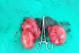 Ca đại phẫu sinh tử cắt khối u tuyến giáp “khổng lồ” cứu người phụ nữ dân tộc Nùng