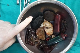 Cứu sống “dị nhân” ăn đủ thứ, từ đá sỏi, bật lửa, túi nilon đến cả... dao lam