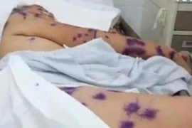 Cấp cứu hai trường hợp bị ong đốt hàng trăm nốt chi chít khắp cơ thể