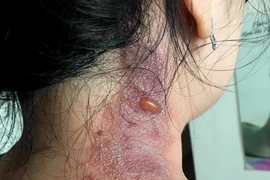 Hàng chục bệnh nhân đến viện do kiến ba khoang đốt dù không phải mùa cao điểm