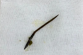 Nam thanh niên thủng ruột non do nuốt phải dị vật khi ăn lẩu