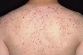 Trị mụn trứng cá ở lưng tại Spa, nữ bệnh nhân 36 tuổi bị sốc phản vệ suýt tử vong