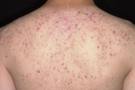 Trị mụn trứng cá ở lưng tại Spa, nữ bệnh nhân 36 tuổi bị sốc phản vệ suýt tử vong