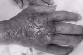 Chín người bị rắn độc cắn do thu dọn đồ đạc, kiểm tra sân vườn sau bão lũ