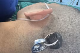 Cấp cứu nam thanh niên bị chìa khóa cắm sâu vào đầu