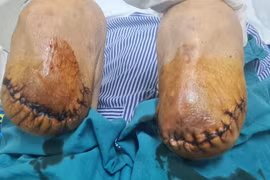 Nam bệnh nhân phải cắt cụt hai chân vì biến chứng của đái tháo đường