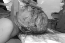 Cứu thành công bệnh nhân bị lột da đầu phức tạp nhất từ trước tới nay, lột cả tai và mí mắt