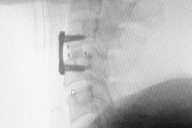 Cứu bệnh nhân ngã gập cổ do tai nạn giao thông khỏi liệt tứ chi