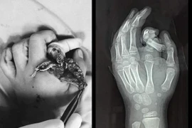 Hà Nội: Đưa tay vào máy giặt đang chạy, bé trai 6 tuổi bị tai nạn nghiêm trọng