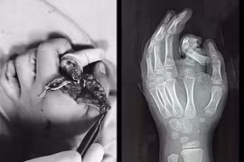 Hà Nội: Đưa tay vào máy giặt đang chạy, bé trai 6 tuổi bị tai nạn nghiêm trọng