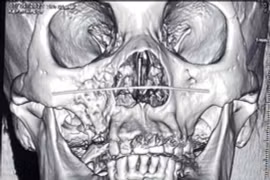 Nóng: Chính thức công bố kết luận về các bệnh nhân bị hoại tử xương hàm mặt sau nhiễm Covid-19