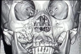 Nóng: Chính thức công bố kết luận về các bệnh nhân bị hoại tử xương hàm mặt sau nhiễm Covid-19