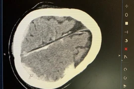 Cứu sống bệnh nhân bị tai nạn giao thông gây dập não, đa chấn thương phức tạp