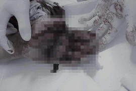 Nam thanh niên ở Hà Nội nhập viện với chi chít vết thương do điện thoại phát nổ