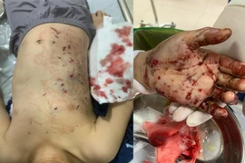 Đồ chơi chứa pin phát nổ, bé trai 10 tuổi nhập viện với đa chấn thương do dị vật găm vào