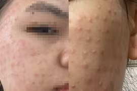 Tiêm chất làm trắng da siêu tốc, cô gái nhập viện với gương mặt chi chít mụn sần