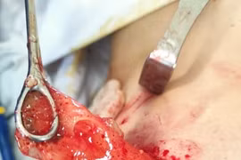 Đặt túi silicon nâng ngực loại “xịn” nhưng vẫn phải nhập viện cầu cứu bác sĩ