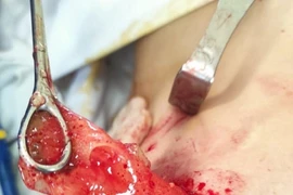 Đặt túi silicon nâng ngực loại “xịn” nhưng vẫn phải nhập viện cầu cứu bác sĩ