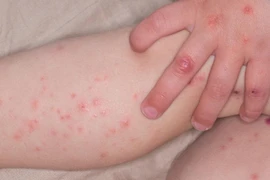 Số trẻ mắc tay chân miệng ở Hà Nội tăng vọt trong một tuần qua