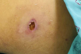 Gần 300 người ở Yên Bái mắc bệnh sốt mò, 1 ca tử vong