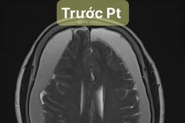 Khoan sọ hút máu tụ dưới màng cứng hai bên bán cầu cứu sống cụ bà 82 tuổi ở Hà Nội