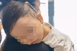 Sơ ý để mẩu dây thép rơi vào nồi cháo nấu cho trẻ, bé 13 tháng tuổi thủng amidan