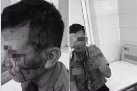Nhân viên bảo vệ Bệnh viện K bị đối tượng chèo kéo người bệnh hành hung, khâu 8 mũi