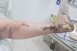 Người phụ nữ 40 tuổi phải cắt cụt 1/3 chân do biến chứng của đái tháo đường