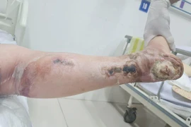 Người phụ nữ 40 tuổi phải cắt cụt 1/3 chân do biến chứng của đái tháo đường