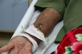 Bó lá thuốc vào tay bị gãy, cụ bà 83 tuổi ở Hà Nội tử vong vì nhiễm uốn ván