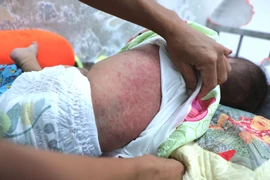 Hà Nội: 50 trẻ mắc sởi trong 1 tuần, số mắc tăng liên tục