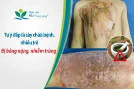 Bé gái 13 tháng tuổi bị nhiễm trùng nặng do người nhà đắp thuốc nam chữa bỏng