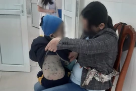 Hà Nội mỗi tuần phát hiện 70-100 ca mắc thủy đậu, ghi nhận nhiều ở ngoại thành